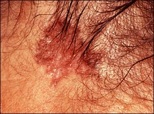 Cáncer de piel o carcinoma de célula basal pigmentado