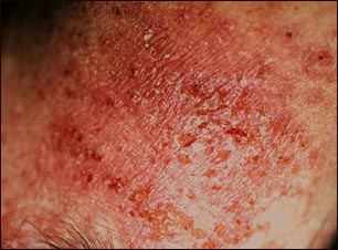 Dermatitis de contacto alérgica; vista de cerca