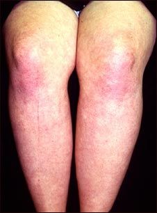 Dermatomiositis en las piernas
