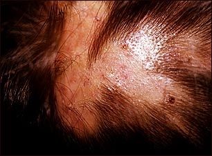 Foliculitis descalvante en el cuero cabelludo