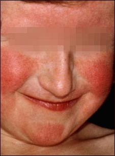 Dermatitis atópica en la cara de una mujer joven