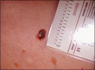 Cáncer de piel: primer plano del melanoma de nivel III
