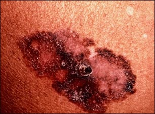 Cáncer de piel o melanoma de propagación superficial