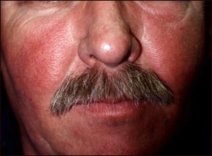 Salpullido facial por lupus eritematoso sistémico