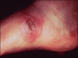 Leishmania panamensis en el pie