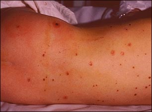 Lesiones meningocócicas en la espalda