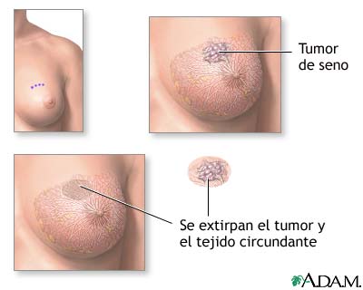 Excisión de un tumor en el seno