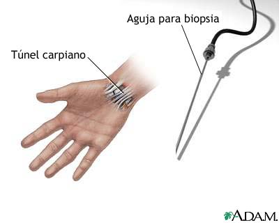 Biopsia carpal