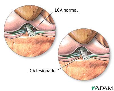 Lesión del ligamento cruzado anterior (LCA)