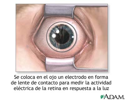 Electrodo de lente de contacto en el ojo