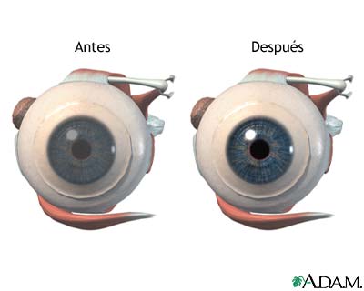 Antes y después de cirugía corneal