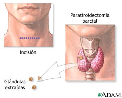 Paratiroidectomía