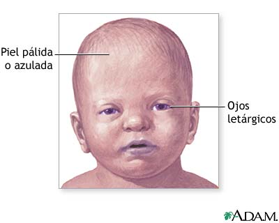 Síntomas del bebé sacudido