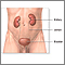 Extirpación quirúrgica del riñón (nefrectomía) - Serie