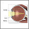 Queratotomía radial para corregir la miopía - Serie