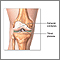 Reemplazo de la articulación de la rodilla - Serie