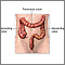 Resección del intestino grueso - Serie