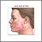 Cirugía para suavizar la superficie de la piel (dermabrasión) - Serie