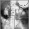 Ileo: Radiografía del estómago e intestino distendido