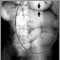 Ileo: Radiografía de la distensión intestinal
