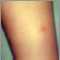 Varicela - Lesión en la pierna