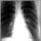 Coccidioidomicosis - radiografía de tórax