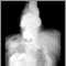 Radiografía de una hernia hiatal