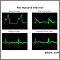Gráficos de las ondas del ECG después del infarto al miocardio