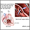 Defecto del tabique ventricular