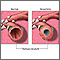 Bronquitis y condición normal de los bronquios terciarios
