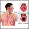 Bronquiolo asmático y bronquiolo normal