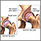 Artritis  en la cadera