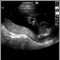 Ultrasonido normal , placenta relajada