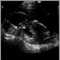 Ultrasonido de un feto normal; vista de perfil