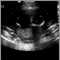 Ultrasonido de un feto normal; ventrículos cerebrales