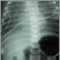 Retorno venoso pulmonar total anómalo, rayos X