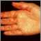Vasculitis en la palma de la mano