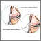 Ligamento colateral lateral desgarrado